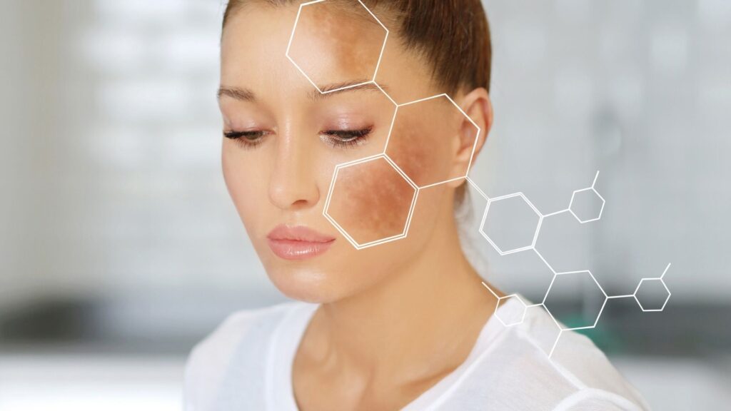 melasma or hyperpigmentation